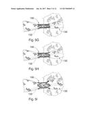 PERCUTANEOUS HEART VALVE diagram and image