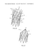 ARTICULATED COMMISSURE VALVE STENTS AND METHODS diagram and image