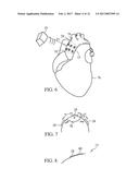 ACOUSTIC THERAPY DEVICE diagram and image