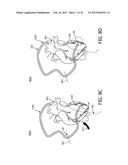 SYSTEM FOR PERFORMING INTRALUMINAL CORONARY AND METHOD OF OPERATION     THEREOF diagram and image