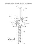 IMPLANTS FOR SECURING SPINAL FIXATION ELEMENTS diagram and image