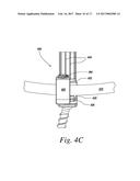 IMPLANTS FOR SECURING SPINAL FIXATION ELEMENTS diagram and image