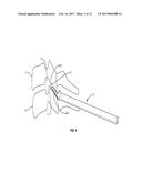 METHODS AND INSTRUMENTS FOR USE IN VERTEBRAL TREATMENT diagram and image