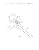 METHODS AND INSTRUMENTS FOR USE IN VERTEBRAL TREATMENT diagram and image