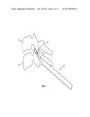 METHODS AND INSTRUMENTS FOR USE IN VERTEBRAL TREATMENT diagram and image