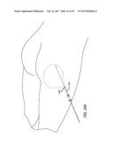 DEVICES AND METHODS FOR PERFORMING SUBCUTANEOUS SURGERY diagram and image