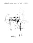 PRECISION ELECTRODE MOVEMENT CONTROL FOR RENAL NERVE ABLATION diagram and image