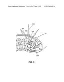 METHOD AND PROBE FOR PROVIDING TACTILE FEEDBACK IN LAPAROSCOPIC SURGERY diagram and image