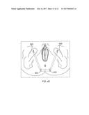 SYSTEM AND METHOD FOR TREATMENT OF ANAL INCONTINENCE AND PELVIC ORGAN     PROLAPSE diagram and image