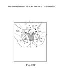 TISSUE ANCHOR AND A SUTURE INSERTED THROUGH THE TISSUE ANCHOR HAVING END     PORTIONS OF THE SUTURE MAINTAINED WITHIN A CONDUIT diagram and image