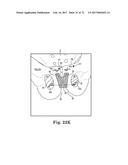 TISSUE ANCHOR AND A SUTURE INSERTED THROUGH THE TISSUE ANCHOR HAVING END     PORTIONS OF THE SUTURE MAINTAINED WITHIN A CONDUIT diagram and image