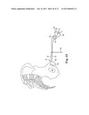 TISSUE ANCHOR AND A SUTURE INSERTED THROUGH THE TISSUE ANCHOR HAVING END     PORTIONS OF THE SUTURE MAINTAINED WITHIN A CONDUIT diagram and image