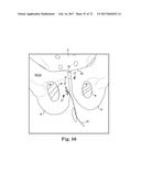 TISSUE ANCHOR AND A SUTURE INSERTED THROUGH THE TISSUE ANCHOR HAVING END     PORTIONS OF THE SUTURE MAINTAINED WITHIN A CONDUIT diagram and image