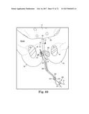 TISSUE ANCHOR AND A SUTURE INSERTED THROUGH THE TISSUE ANCHOR HAVING END     PORTIONS OF THE SUTURE MAINTAINED WITHIN A CONDUIT diagram and image