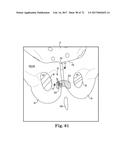 TISSUE ANCHOR AND A SUTURE INSERTED THROUGH THE TISSUE ANCHOR HAVING END     PORTIONS OF THE SUTURE MAINTAINED WITHIN A CONDUIT diagram and image