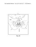 TISSUE ANCHOR AND A SUTURE INSERTED THROUGH THE TISSUE ANCHOR HAVING END     PORTIONS OF THE SUTURE MAINTAINED WITHIN A CONDUIT diagram and image