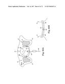 TISSUE ANCHOR AND A SUTURE INSERTED THROUGH THE TISSUE ANCHOR HAVING END     PORTIONS OF THE SUTURE MAINTAINED WITHIN A CONDUIT diagram and image