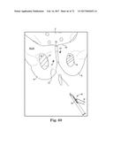 TISSUE ANCHOR AND A SUTURE INSERTED THROUGH THE TISSUE ANCHOR HAVING END     PORTIONS OF THE SUTURE MAINTAINED WITHIN A CONDUIT diagram and image