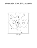 TISSUE ANCHOR AND A SUTURE INSERTED THROUGH THE TISSUE ANCHOR HAVING END     PORTIONS OF THE SUTURE MAINTAINED WITHIN A CONDUIT diagram and image