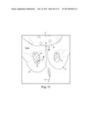 TISSUE ANCHOR AND A SUTURE INSERTED THROUGH THE TISSUE ANCHOR HAVING END     PORTIONS OF THE SUTURE MAINTAINED WITHIN A CONDUIT diagram and image