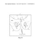 TISSUE ANCHOR AND A SUTURE INSERTED THROUGH THE TISSUE ANCHOR HAVING END     PORTIONS OF THE SUTURE MAINTAINED WITHIN A CONDUIT diagram and image