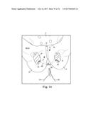 TISSUE ANCHOR AND A SUTURE INSERTED THROUGH THE TISSUE ANCHOR HAVING END     PORTIONS OF THE SUTURE MAINTAINED WITHIN A CONDUIT diagram and image