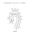 INTEGRATED EMBOLIC PROTECTION DEVICES diagram and image