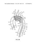 INTEGRATED EMBOLIC PROTECTION DEVICES diagram and image