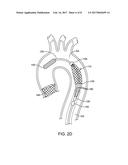 INTEGRATED EMBOLIC PROTECTION DEVICES diagram and image