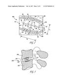 EXPANDABLE IMPLANT diagram and image