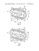 EXPANDABLE IMPLANT diagram and image