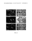 TREATMENT OF COMPLEMENT-ASSOCIATED DISORDERS diagram and image