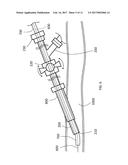 Steerable Aspiration Catheter System diagram and image