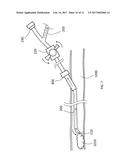 Steerable Aspiration Catheter System diagram and image