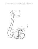 LEAD DELIVERY DEVICE AND METHOD diagram and image