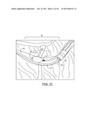 LEAD DELIVERY DEVICE AND METHOD diagram and image