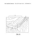 LEAD DELIVERY DEVICE AND METHOD diagram and image