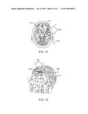 Radiosurgical Neuromodulation Devices, Systems, and Methods for Treatment     of Behavioral Disorders by External Application of Ionizing Radiation diagram and image