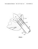 Apical Closure System diagram and image