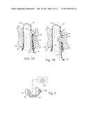 ENDOLUMINAL TREATMENT METHOD AND ASSOCIATED SURGICAL ASSEMBLY diagram and image