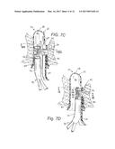 ENDOLUMINAL TREATMENT METHOD AND ASSOCIATED SURGICAL ASSEMBLY diagram and image