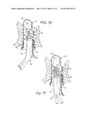 ENDOLUMINAL TREATMENT METHOD AND ASSOCIATED SURGICAL ASSEMBLY diagram and image