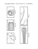 MECHANICAL THROMBECTOMY APPARATUSES AND METHODS diagram and image