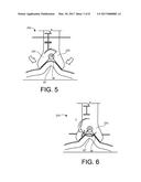 IMPLANT FIXATION DEVICES AND METHODS OF USING THE SAME diagram and image