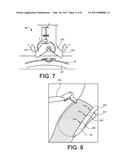 IMPLANT FIXATION DEVICES AND METHODS OF USING THE SAME diagram and image