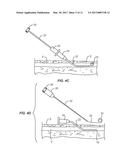 Systems And Methods For Venipuncture And Catheter Placement diagram and image