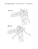ANATOMICAL HUMERAL FIXATION SYSTEM AND METHOD diagram and image