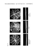 THERAPEUTIC AGENT FOR OCULAR FUNDUS DISEASE diagram and image