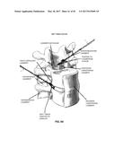 METHOD AND APPARATUS FOR CLOSING A FISSURE IN THE ANNULUS OF AN     INTERVERTEBRAL DISC, AND/OR FOR EFFECTING OTHER ANATOMICAL REPAIRS AND/OR     FIXATIONS diagram and image