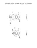 VIBRATION AND INERTIA ENHANCED ATHERECTOMY diagram and image